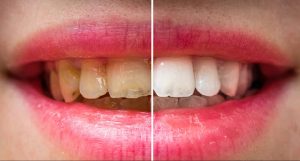 Yellow Teeth Home remedies