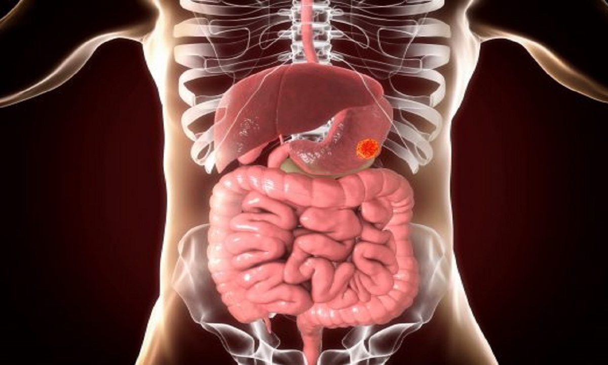 stomach cancer