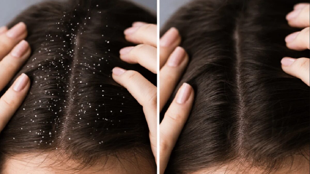 Dandruff Removal Tips