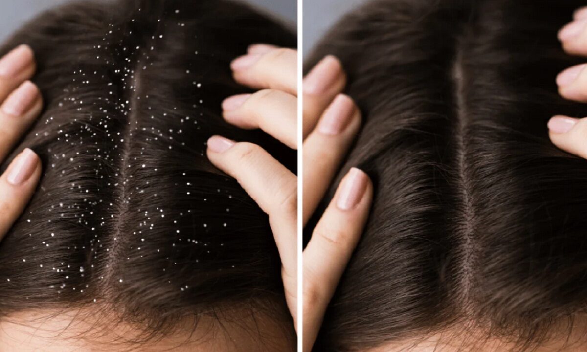 Dandruff Removal Tips