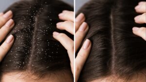 Dandruff Removal Tips