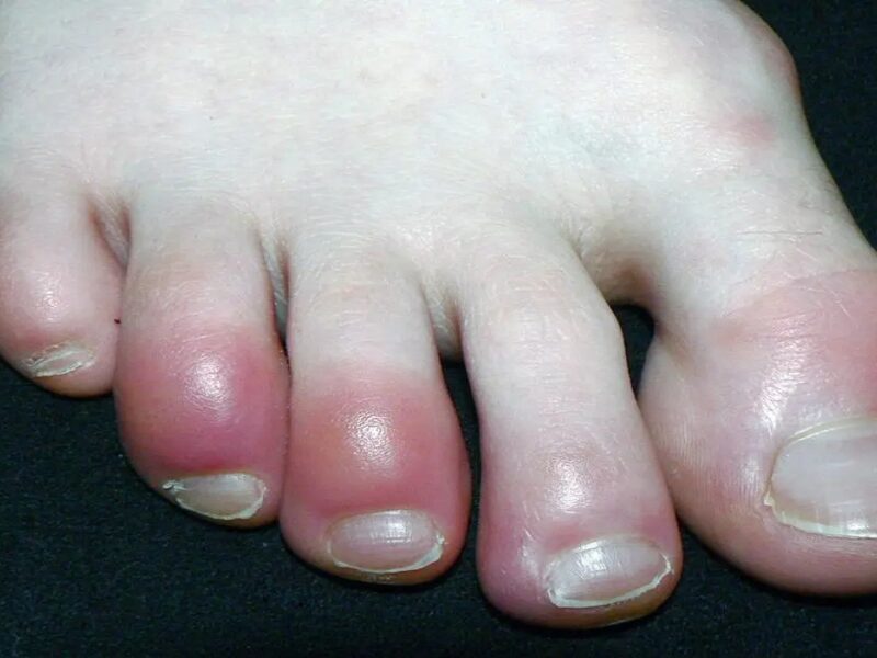 Swelling toes