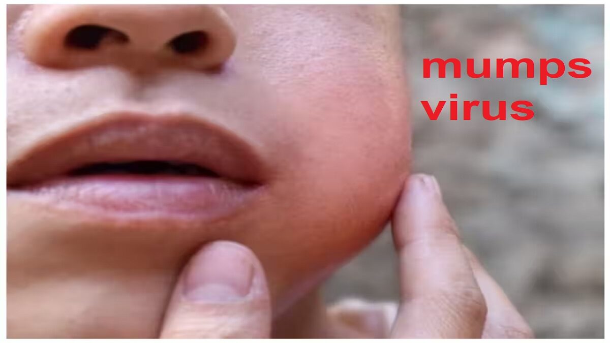 mumps virus