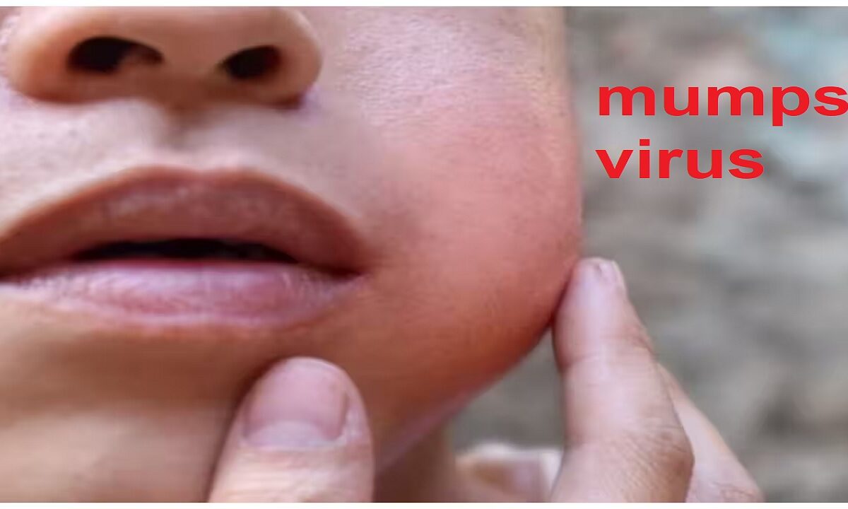 mumps virus