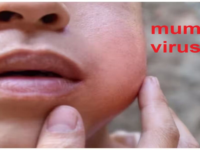 mumps virus