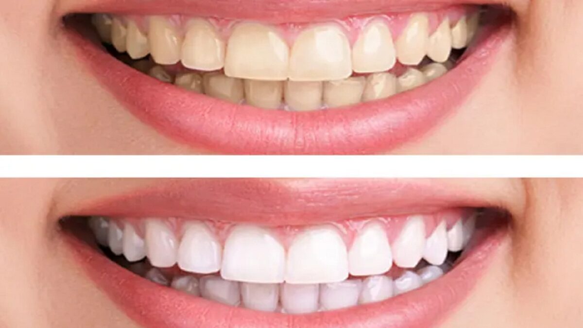 problem of yellowing of teeth