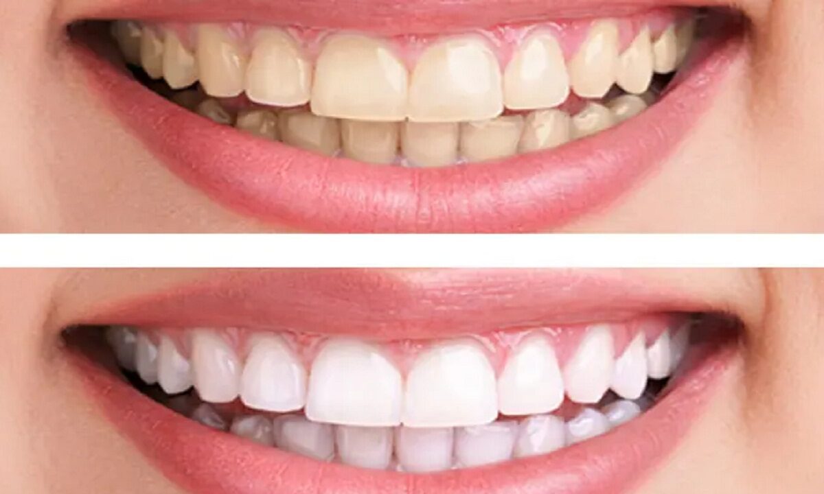 problem of yellowing of teeth
