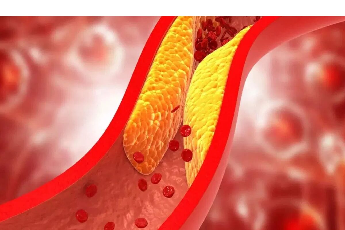 Cholesterol Control Tips