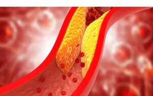 Cholesterol Control Tips