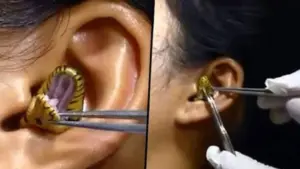 Snake Inside The Ear: लड़की के कान में घुसा सांप, डॉक्टर भी हुए हैरान